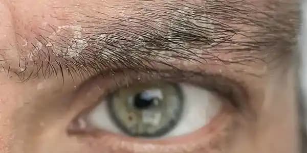 Seboreik Egzama ve Kaş Kepeklenmesi Nedenleri Belirtileri ve Tedavi Yöntemleri