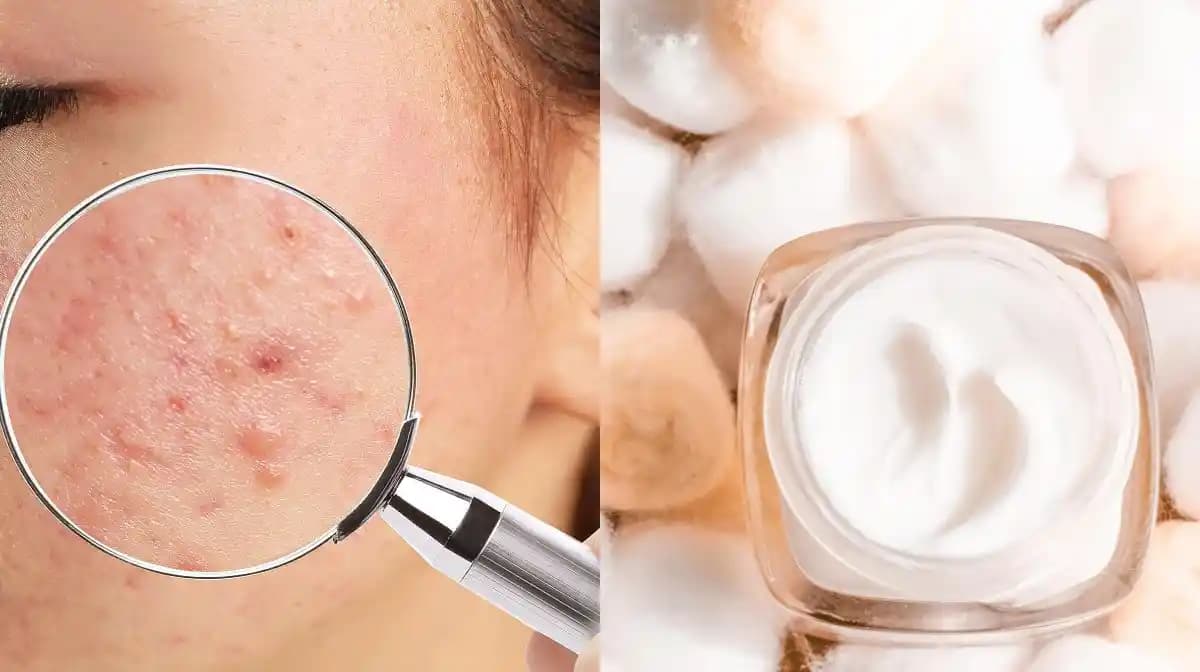 Sivilce ve Keemi İçin En Etkili Kozmetik Çözüm Yöntemleri ve Ürün Seçimi