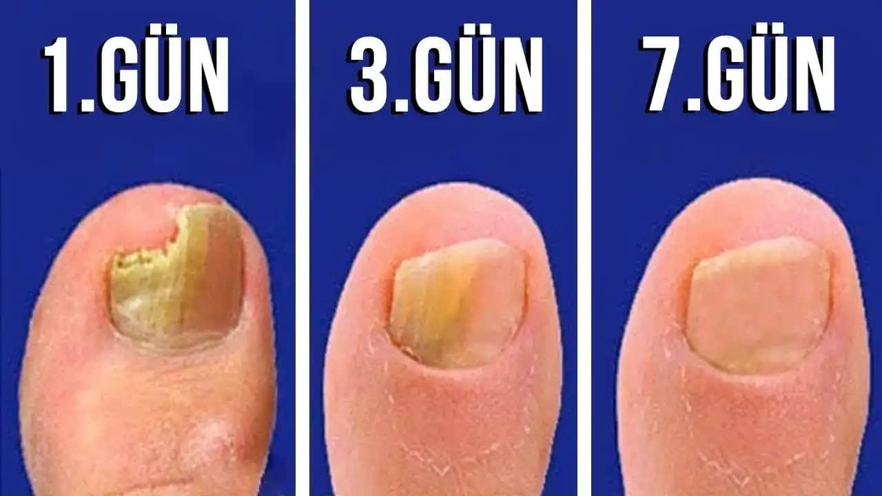 Siyah Tırnak Mantarı Nasıl Geçer En Etkili Tedavi Yöntemleri ve Önlemler