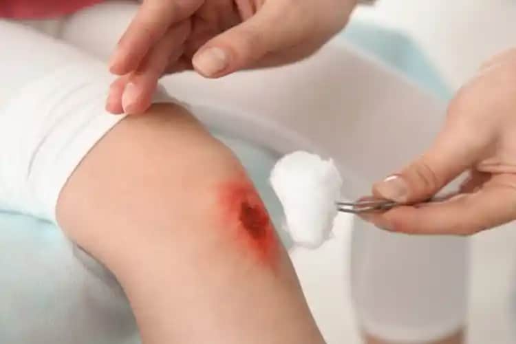 Vazelin Kullanımı ve Yaralara Uygunluk: Cilt Bakımında Bilmeniz Gerekenler