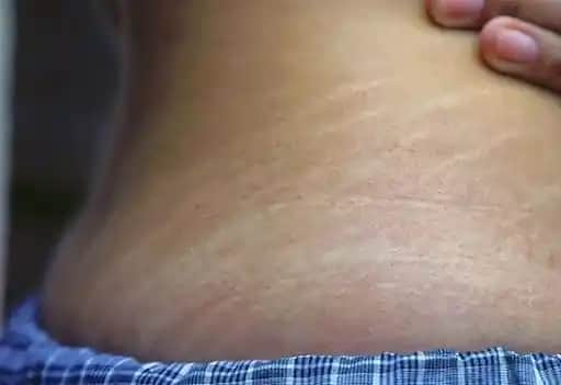 Vücut Çatlakları Nasıl Geçer ve Önleme Yöntemleri Hakkında Bilgiler