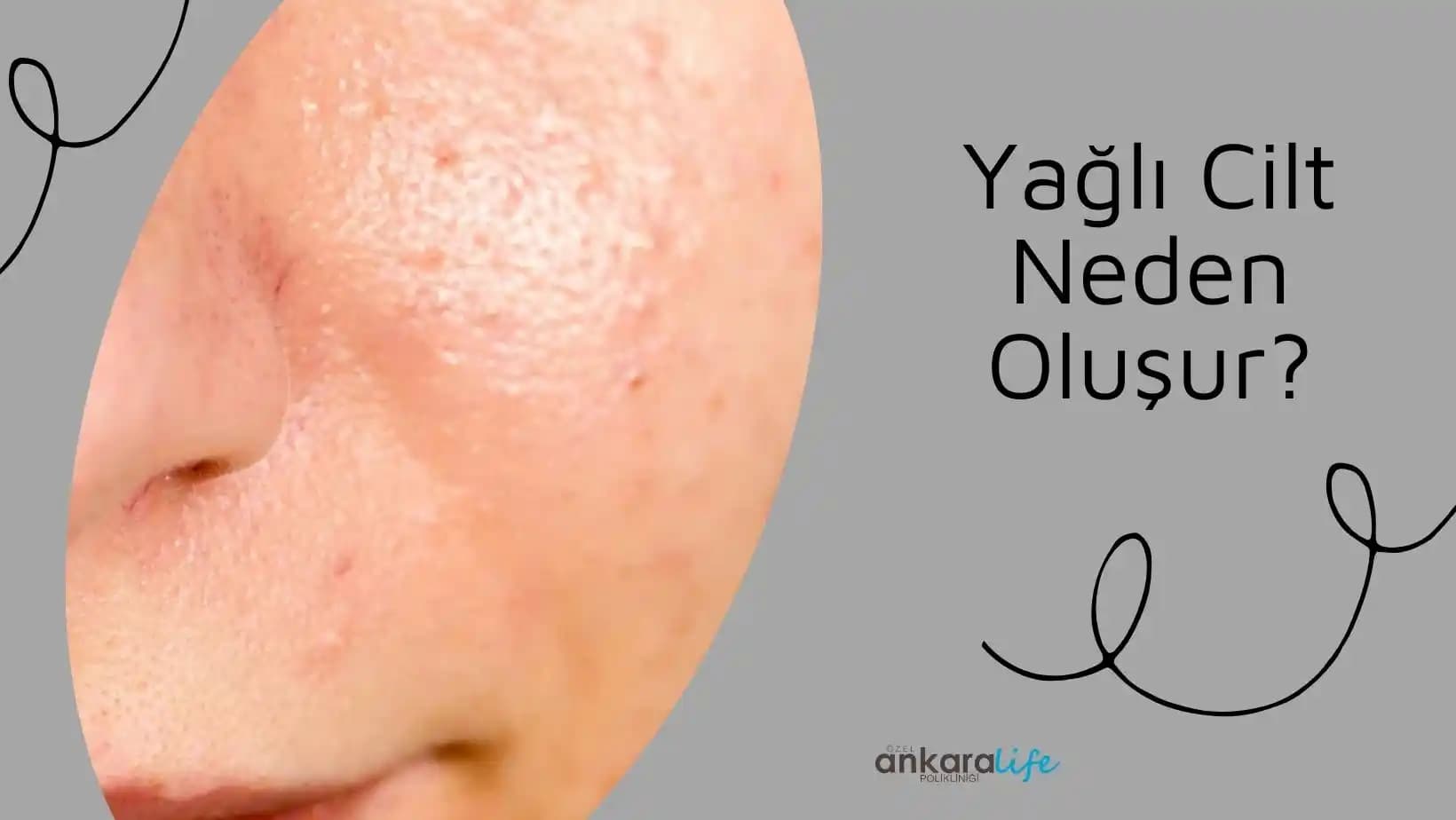 Yağlı Cilt Nedir, Belirtileri ve Doğru Bakım Yöntemleri Hakkında Detaylı Bilgi