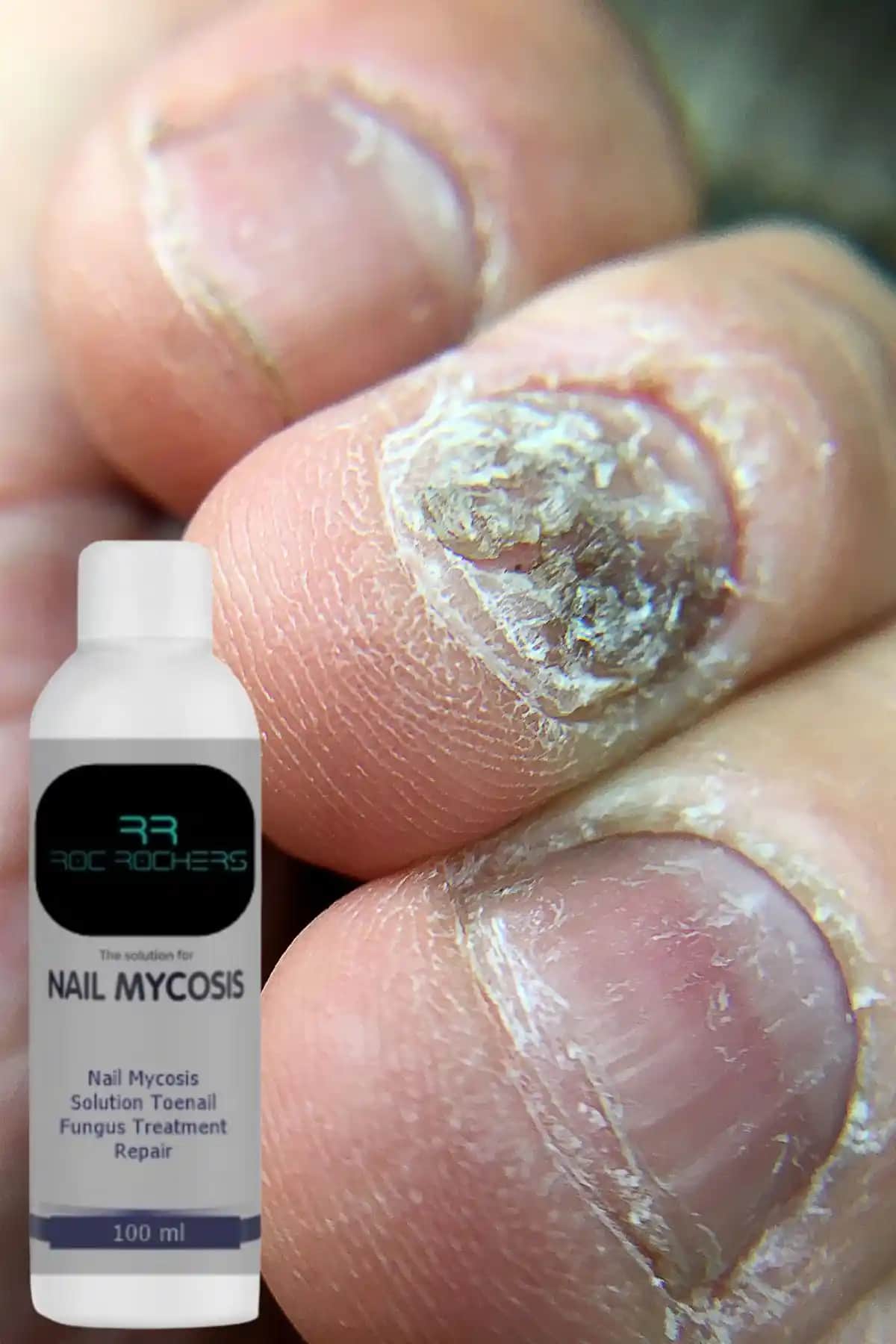 Ayak Tırnağı Mantarına Karşı En Etkili Tedavi Yöntemleri Analizi