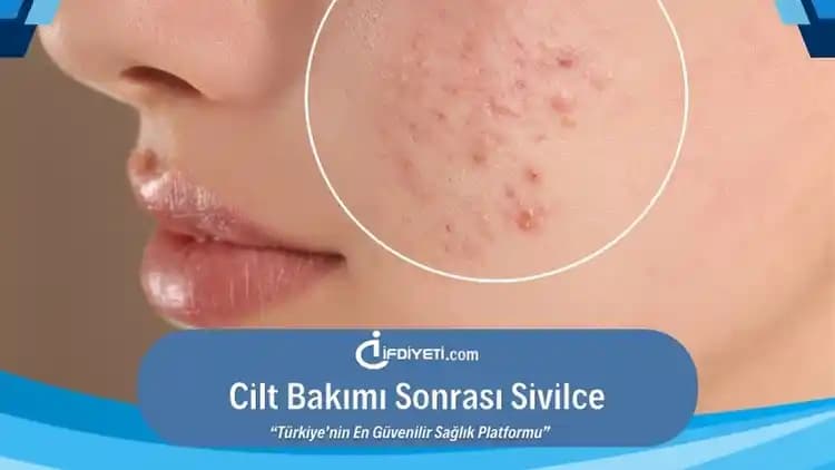 4 Aydan Uzun Süren Sivilceler İçin Nedenler ve Etkili Çözüm Yolları