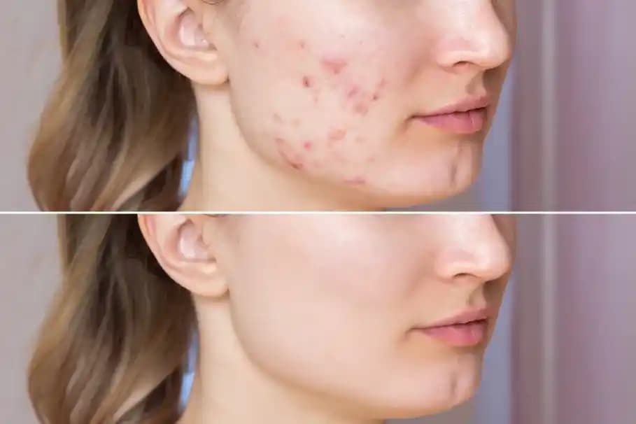 Akne İzlerinin Oluşma Nedenleri ve Cilt Sağlığını Koruma Yöntemleri
