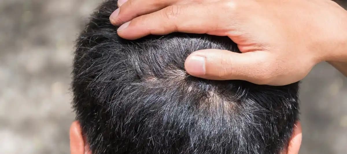 Aşırı Kafa Derisi Kaşıntısı İçin Doğal ve Güvenli Çözüm Yöntemleri