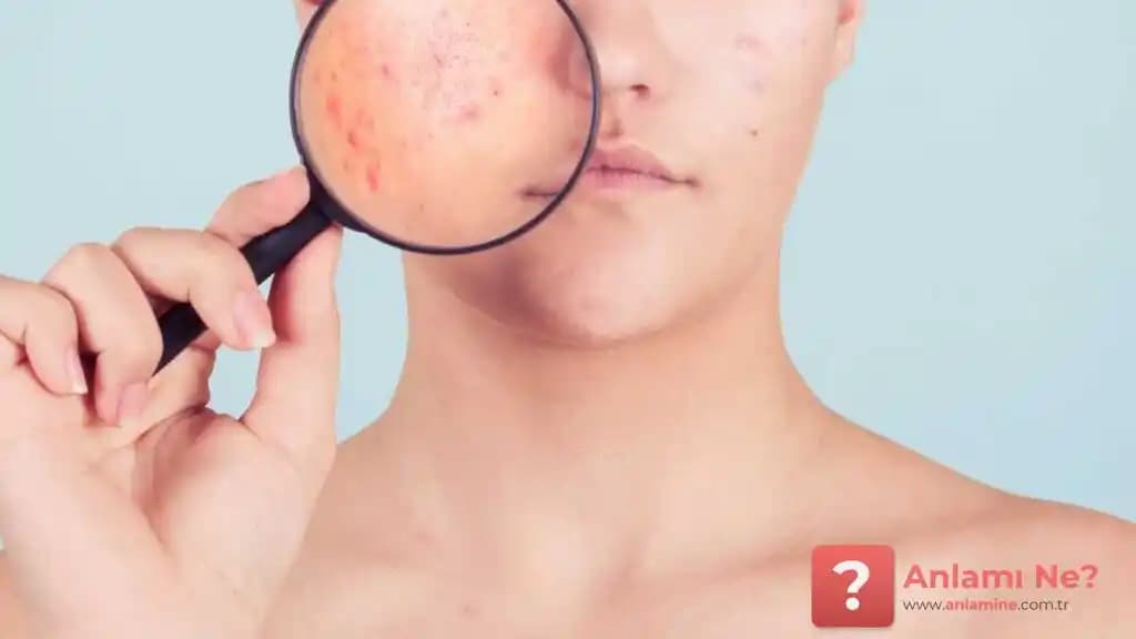 Bilinçli Bakım ve Sivilce Tedavisinde Temel Yaklaşımlar