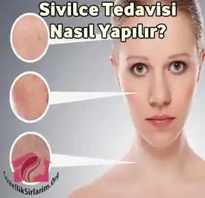 Bilinçli Cilt Bakımı ve Güncel Sivilce Tedavi Yöntemleri Hakkında Detaylı Rehber