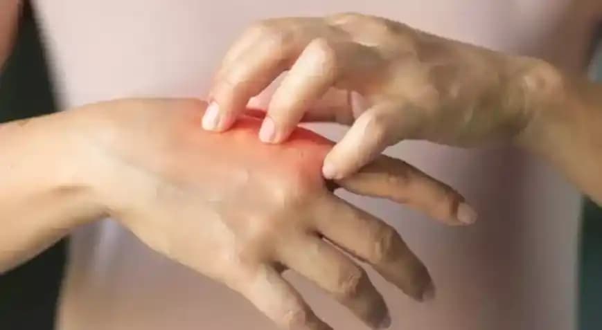 Cilt Alerjisi Çeşitleri ve Belirtileri Hakkında Kapsamlı Bilgi