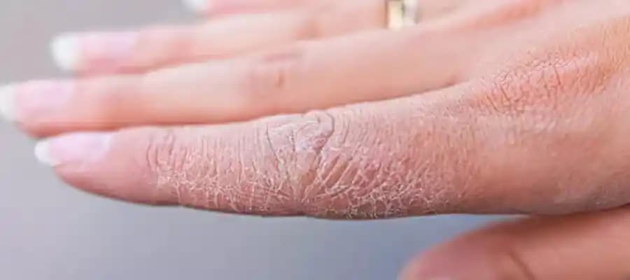 Cilt Kuruluğu Belirtileri ve Etkili Çözüm Yolları Hakkında Kapsamlı Rehber