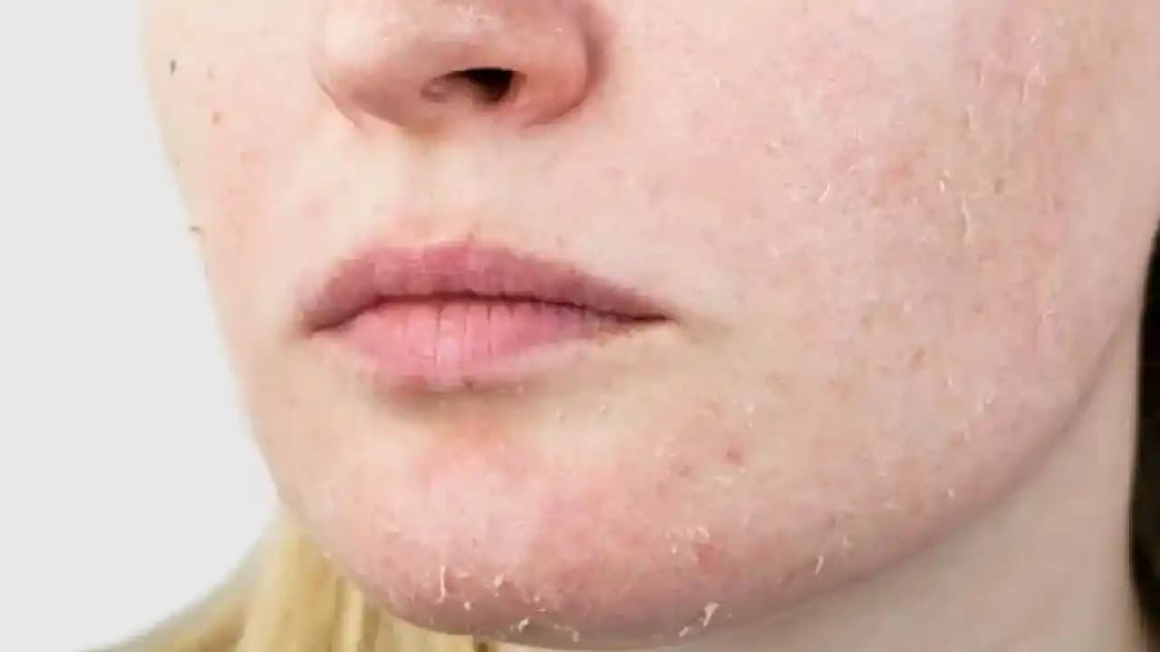 Cilt Kuruluğu Nedir, Belirtileri, Nedenleri ve Etkili Tedavi Yöntemleri