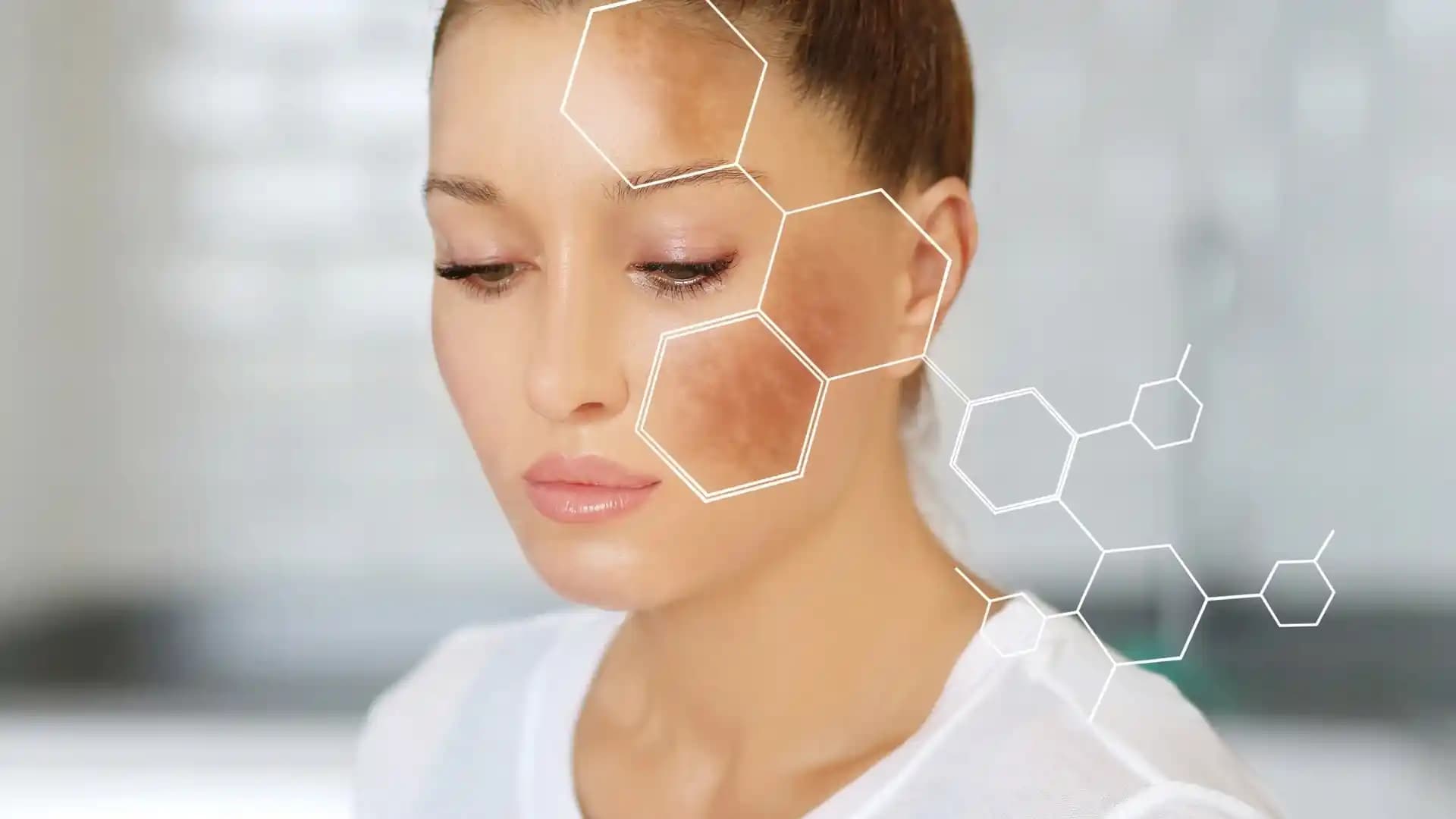 Cilt Lekeleri Neden Oluşur ve Korunma Yöntemleri Hakkında Bilmeniz Gerekenler