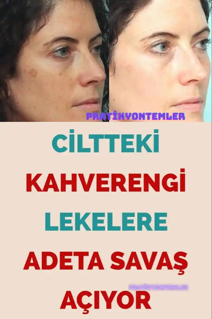 Cilt Lekelerine Karşı Doğal ve Güvenli Yöntemler ile Cilt Sağlığını Destekleme