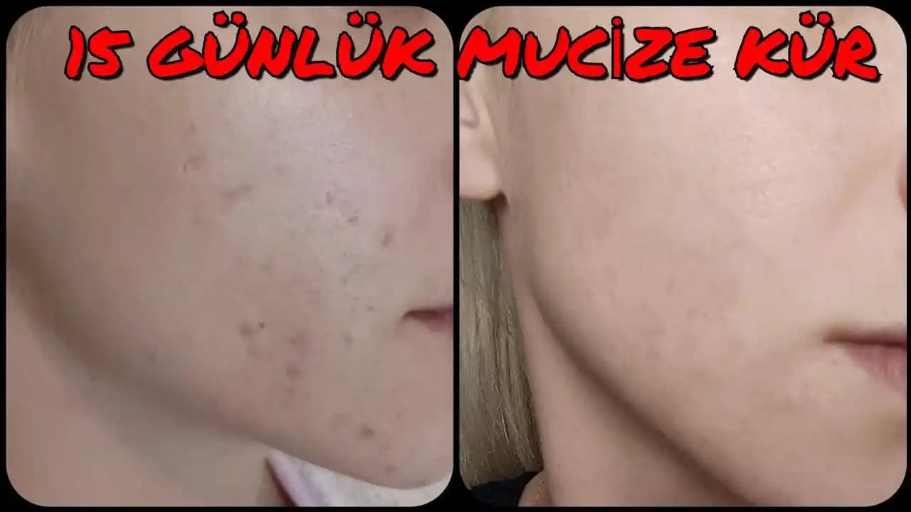 Cilt Problemleri İçin Güncel ve Doğal Çözüm Yaklaşımları