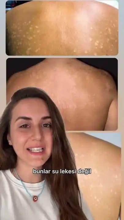 Cilt ve Sırt Lekeleri İçin Etkili Bakım Yöntemleri ve Uygulama İpuçları