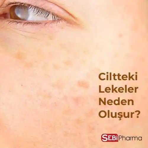 Ciltte Pembe Lekelerin Nedenleri ve Koruyucu Yöntemler