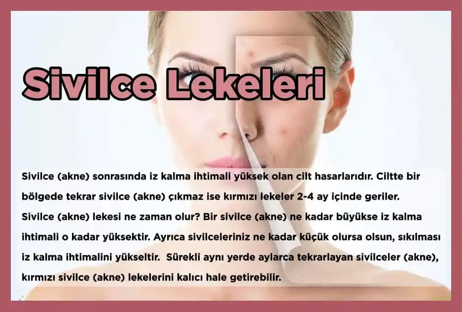 Ciltte Sivilce Lekeleri ve Önleyici Yollar: Etkili Tedavi ve Bakım İpuçları