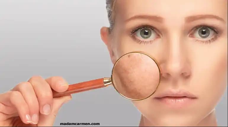 Doğal Yöntemlerle Gözenekleri Sıkılaştırma: Güvenilir ve Etkili Cilt Bakım Teknikleri