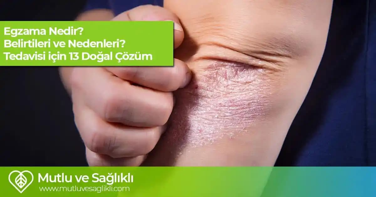 Egzama Tedavisinde Doğal Çözüm Yöntemleri ve Bitkisel Alternatifler