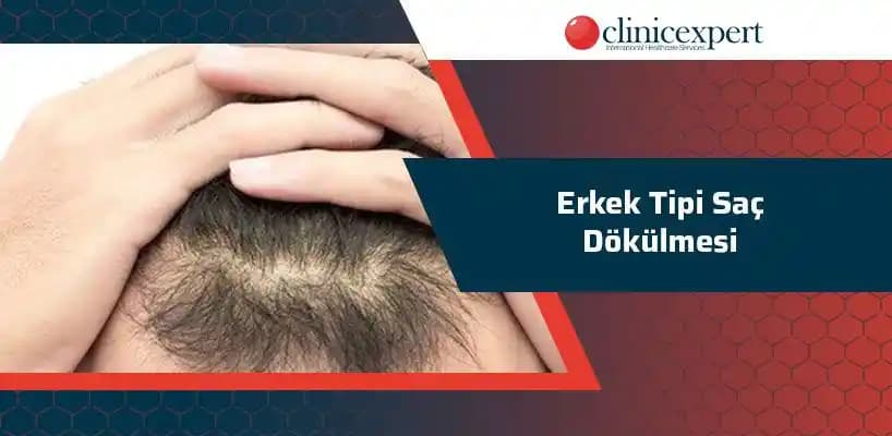 Erkekler İçin Güvenilir Saç Dökülmesi Bakım Yöntemleri ve Ürün Seçimi Rehberi