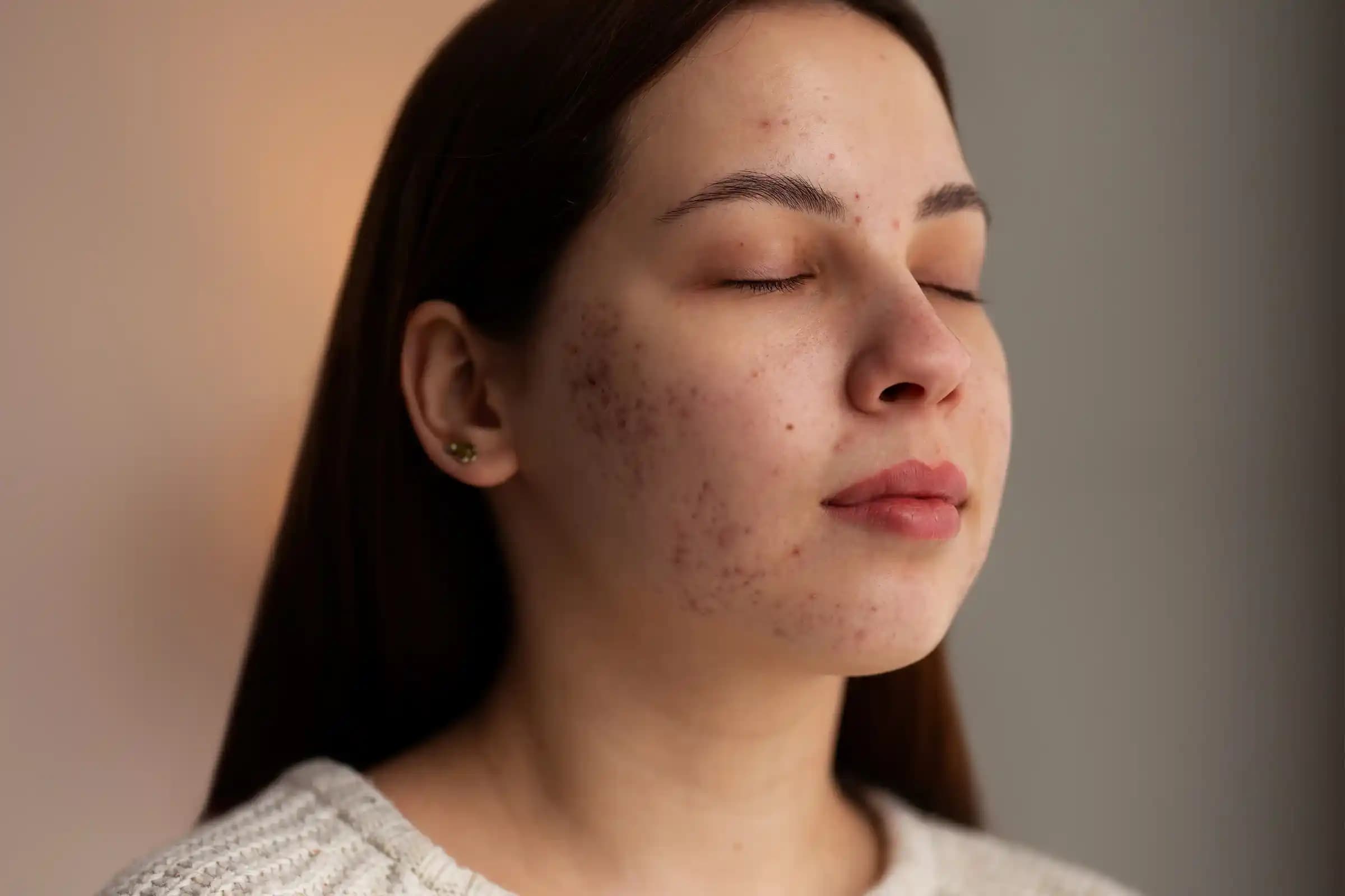 Etkili Sivilce Tedavi ve Bakım İpuçları: Cilt Sağlığını Koruma Yöntemleri