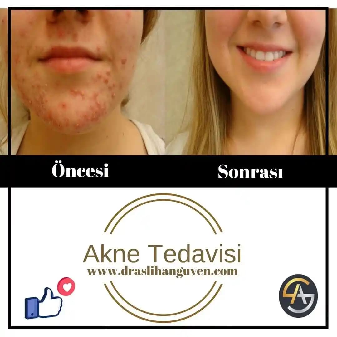 Etkili ve Güvenilir Akne Tedavisi Yöntemleri ve Güncel Ürünler Rehberi