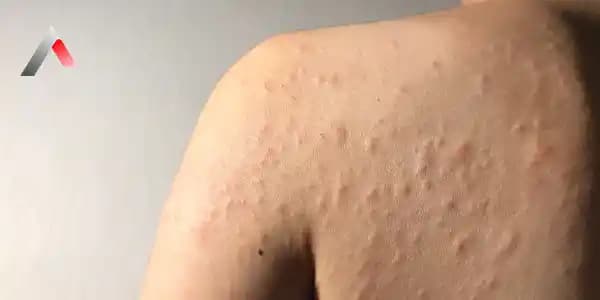 Farklı Cilt Alerjisi Türleri ve Belirtileri Hakkında Kapsamlı Bilgi