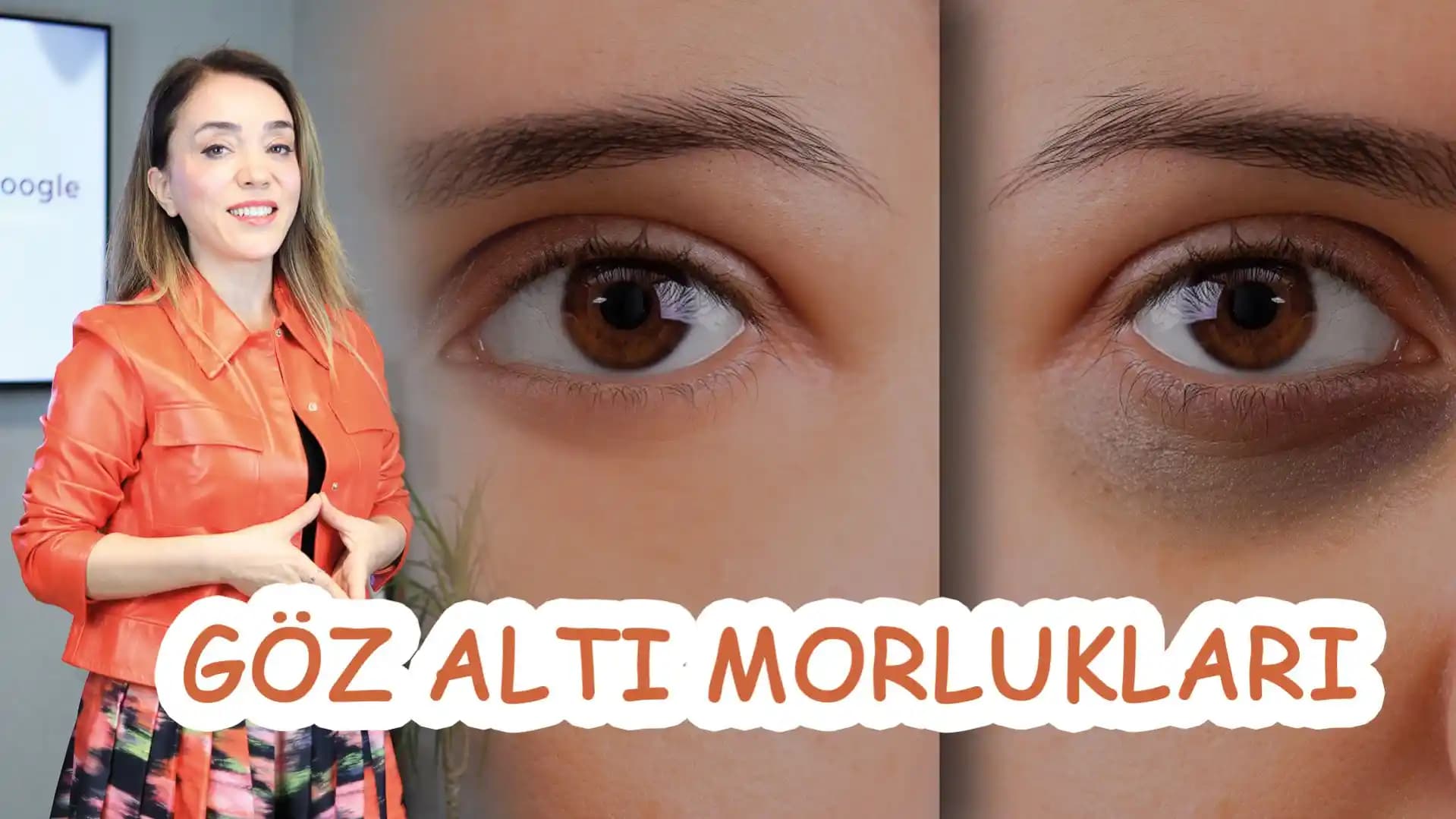 Göz Altı Morlukları Nedenleri ve Etkili Bakım Yöntemleri Hakkında Bilgi