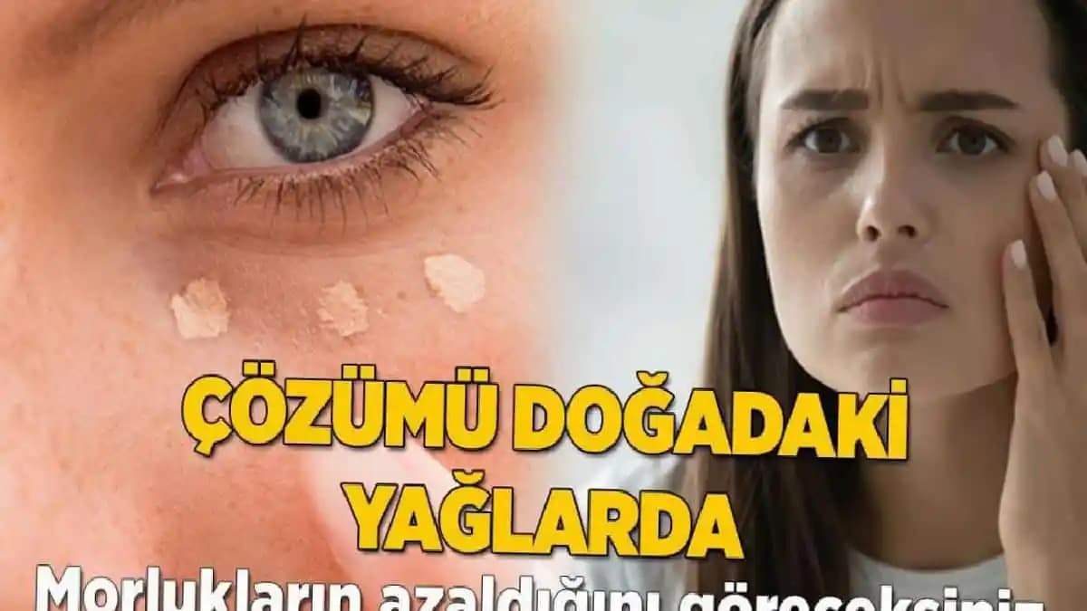 Göz Altı Morlukları Nedenleri ve Etkili Tedavi Yöntemleri Hakkında Bilgiler