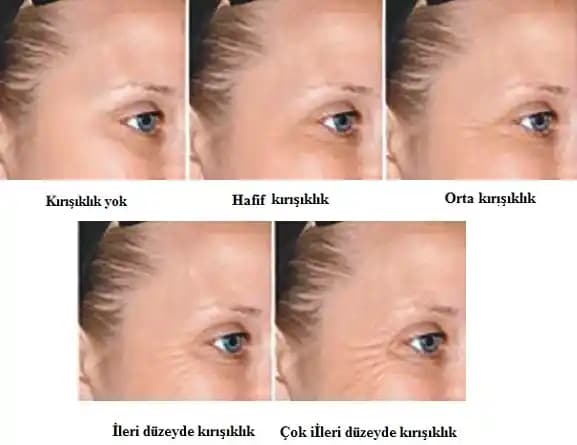 Göz Kenarı ve Kirpik Kırışıklıklarını Önlemenin Etkili Yolları ve Bakım İpuçları