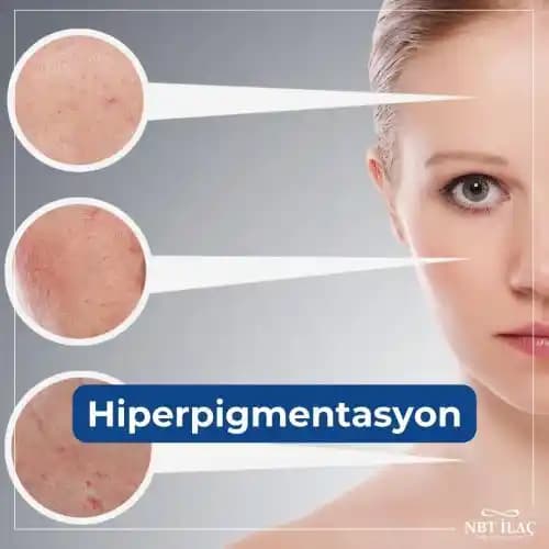 Hiperpigmentasyon İçin Güncel Bakım Yöntemleri ve Koruma Stratejileri