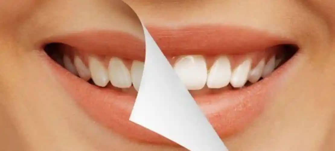 Hollywood Gülümseme: Estetik ve Sağlıklı Gülümsemeye Ulaşmanın Yolları