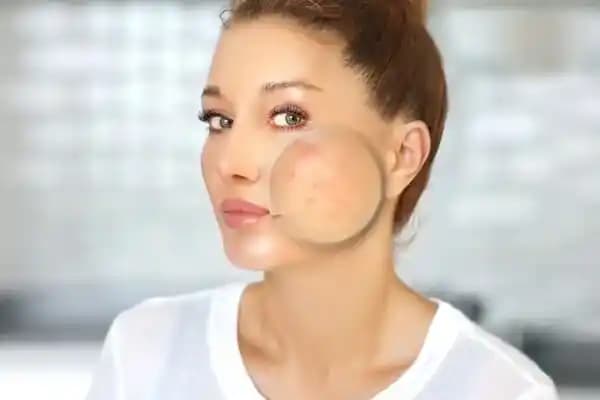 İltihaplı Sivilcelere Karşı Doğal Çözümler ve Cilt Bakım İpuçları