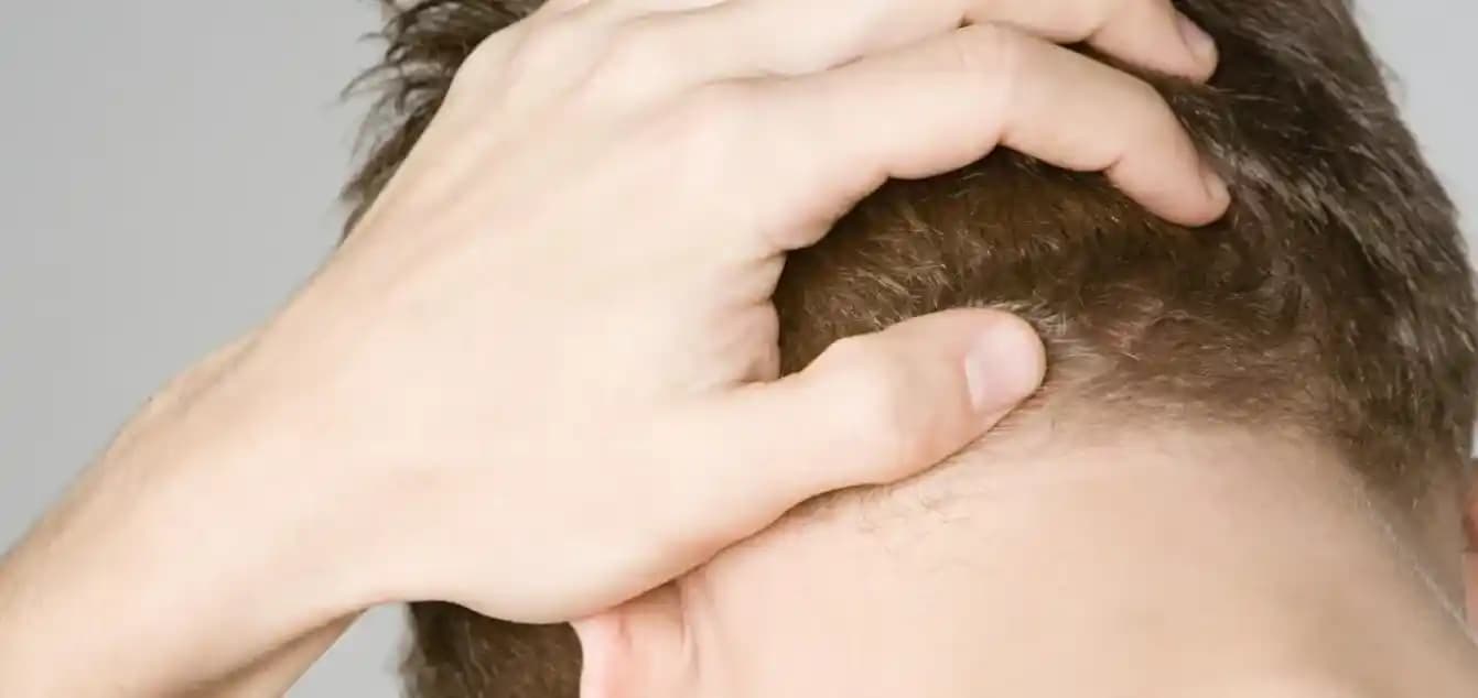 Kafa Derisi Kaşıntısı ve Çözüm Yöntemleri: Doğru Bakım ile Rahatlama
