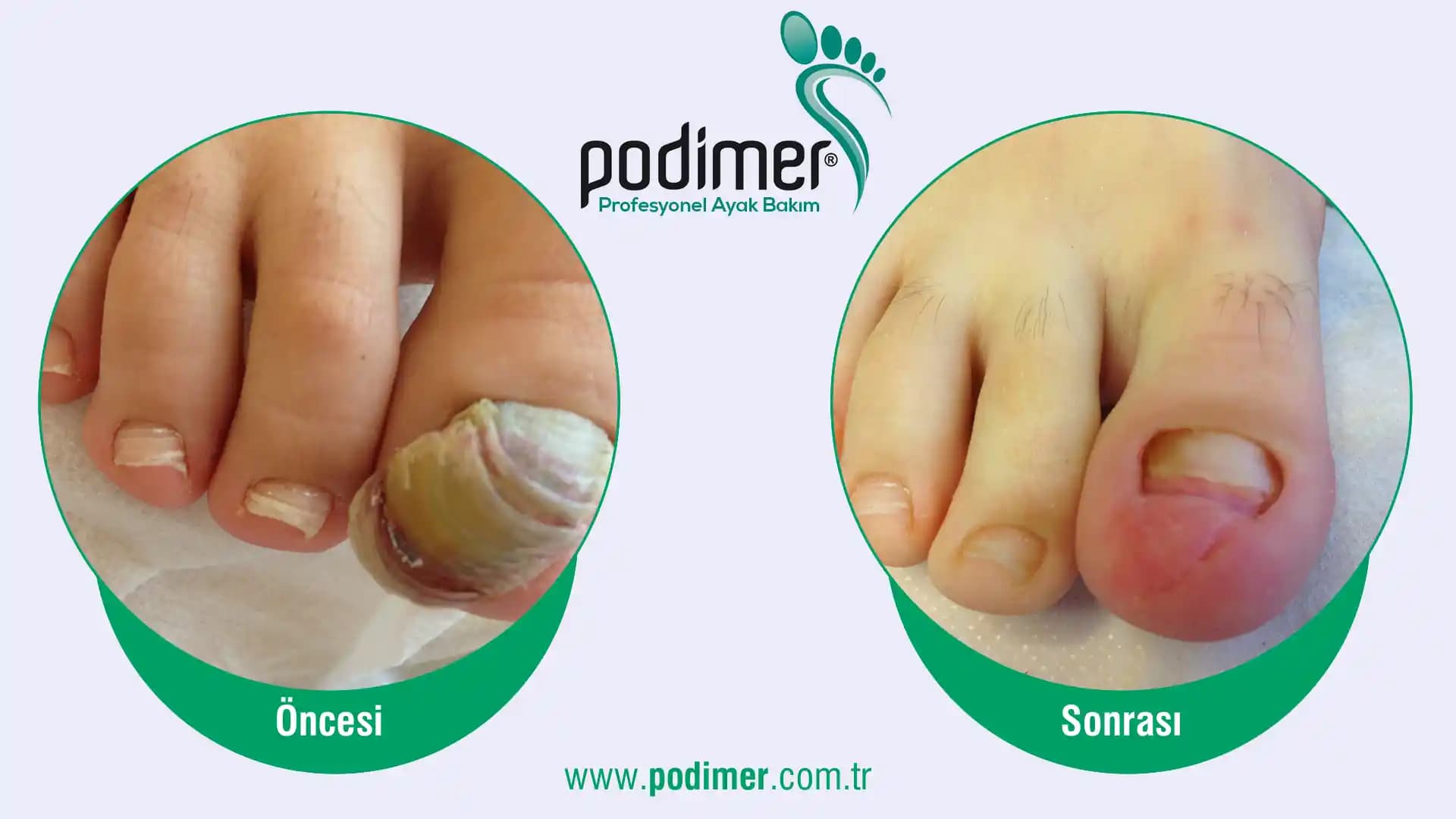 Protez Tırnak Kullanımında Tırnak Mantarı Riskleri ve Korunma Yöntemleri