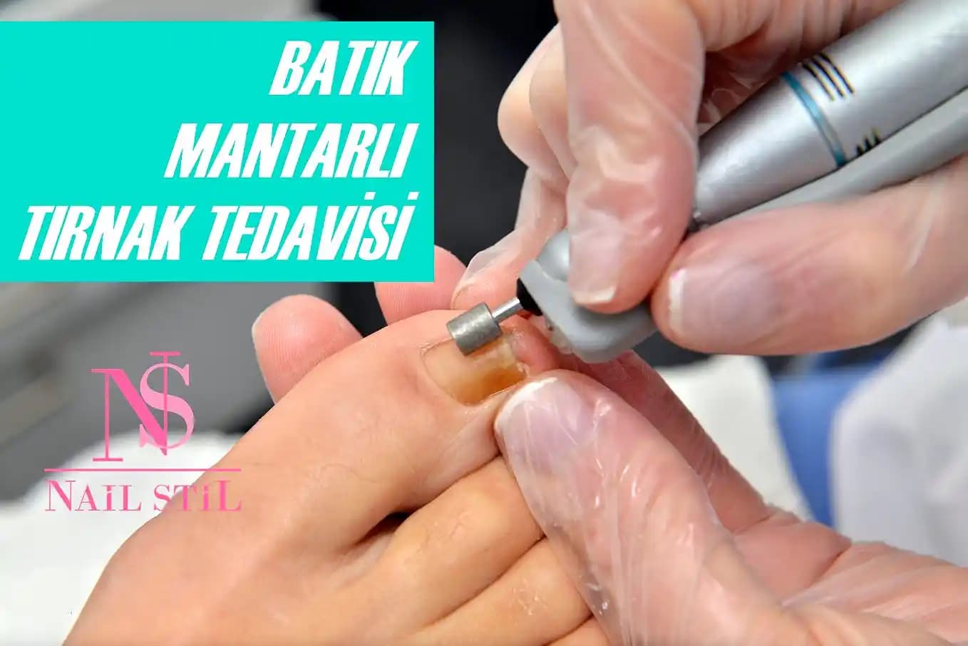 Protez Tırnak ve Mantar Enfeksiyonu: Riskler, Belirtiler ve Koruma Yöntemleri