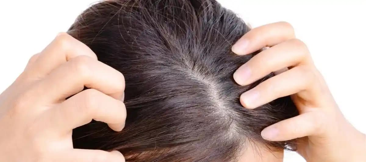 Saç Derisi Rahatsızlıkları ve Doğal ile Profesyonel Çözüm Yöntemleri