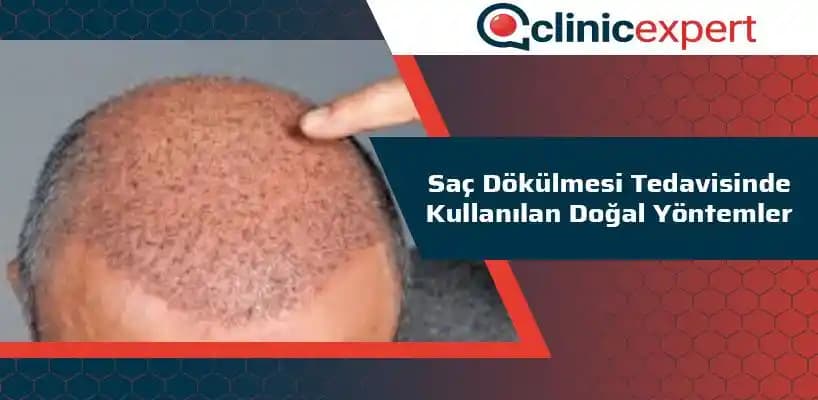 Saç Dökülmesine Karşı Doğal ve Modern Tedavi Yöntemleri Rehberi