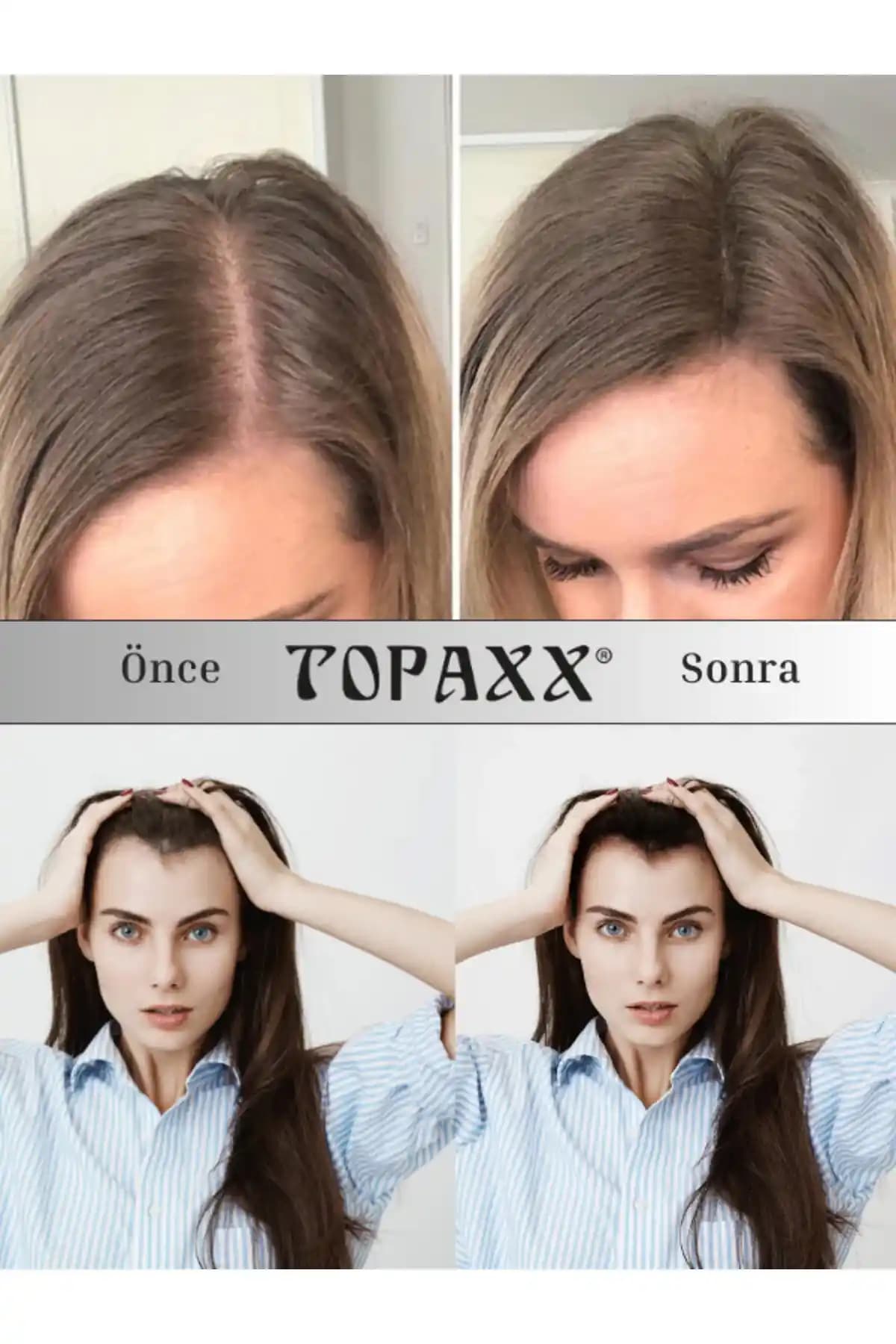 Saç Dökülmesine Karşı Topikal Tedavi Yaklaşımları ve Etkili Kullanım Yöntemleri