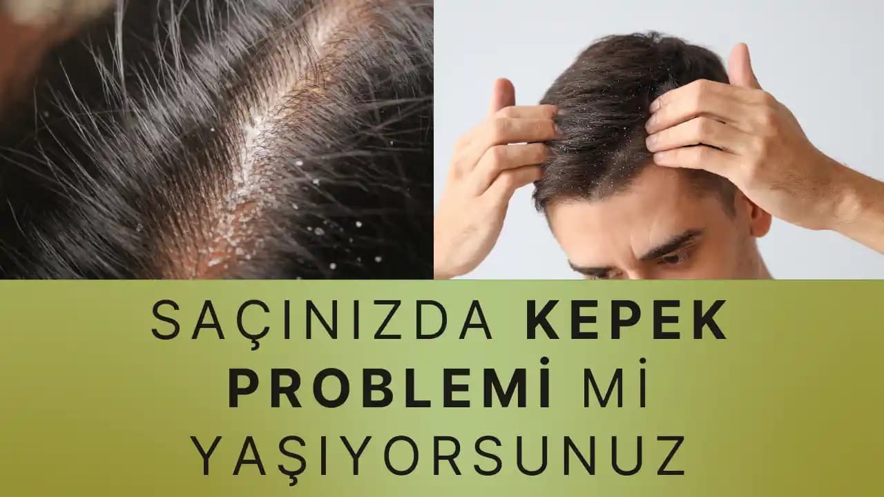Saç ve Saç Derisi Sağlığı İçin Kepekle Mücadelede Bilimsel ve Doğal Yaklaşımlar