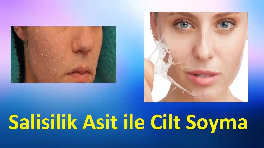 Salisilik Asit ile Cilt Problemlerine Etkili Çözüm ve Kullanım Yöntemleri