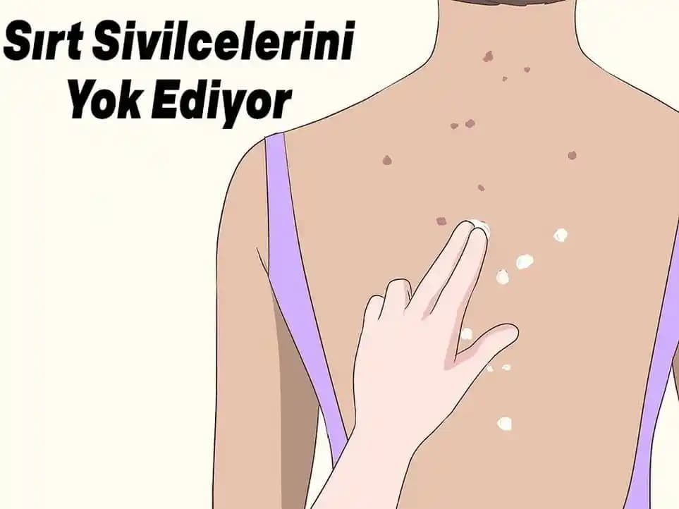 Sırt Aknesi İçin Doğal Çözüm ve Bakım İpuçları: Etkili Yöntemler ve Tavsiyeler