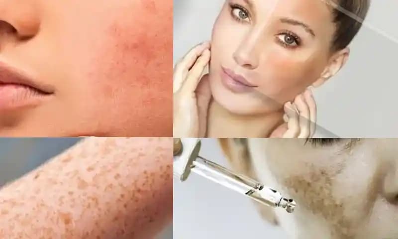 Sırt Lekeleri Nedenleri ve Etkili Çözüm Yolları Cilt Sağlığını Koruma Rehberi