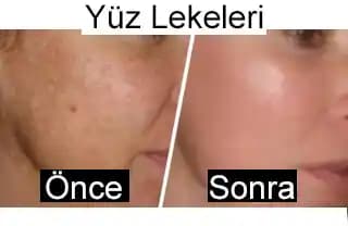 Sırt Lekeleri Önleme ve Günlük Bakım İpuçları Sağlıklı Cilt İçin