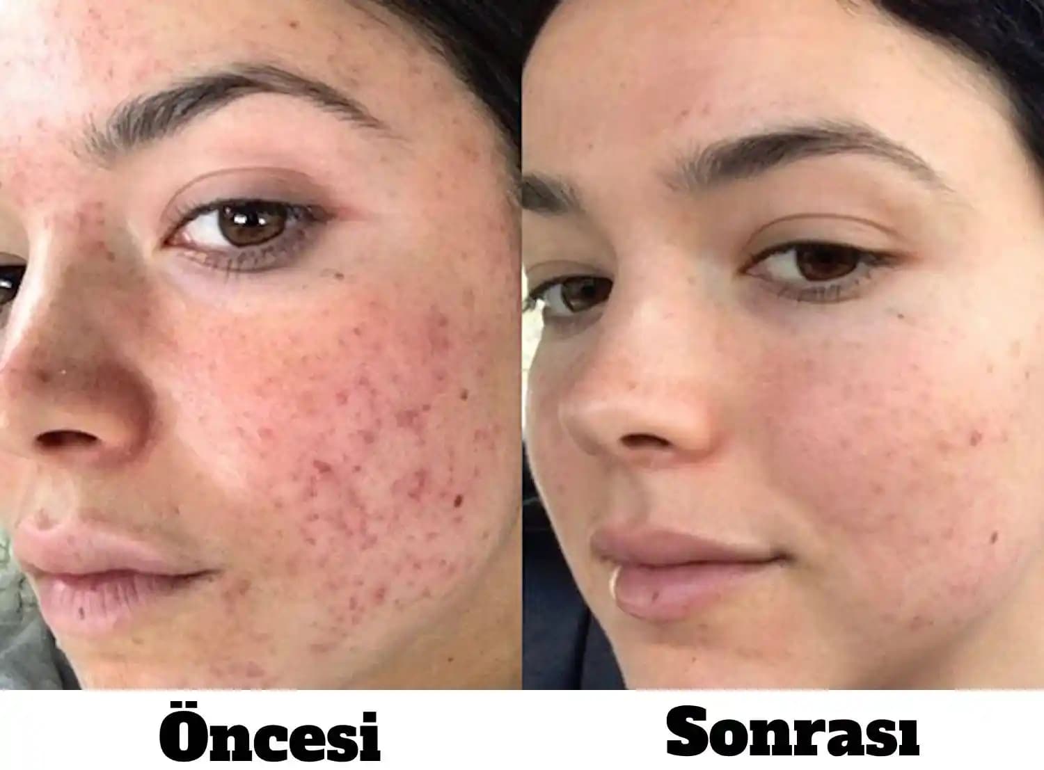 Sivilce İzleri İçin Lazer Tedavisi: Güncel Yöntemler ve Uygulama Detayları