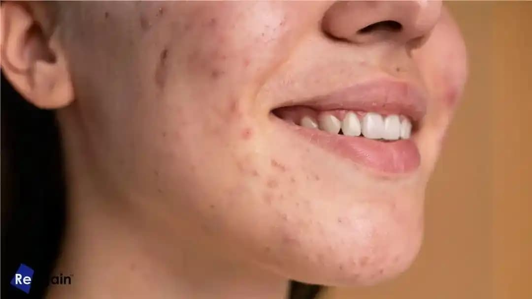 Sivilce İzleri Neden Oluşur ve Etkili Tedavi Yöntemleri Hakkında Bilgi