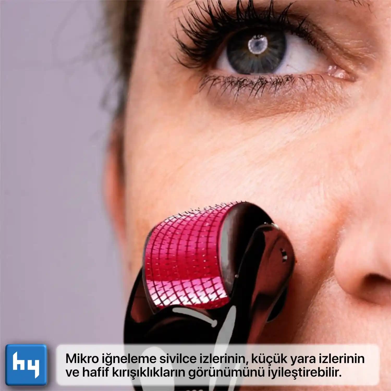 Sivilce İzleri Nedenleri ve Etkili Çözüm Yöntemleri Hakkında Bilmeniz Gerekenler