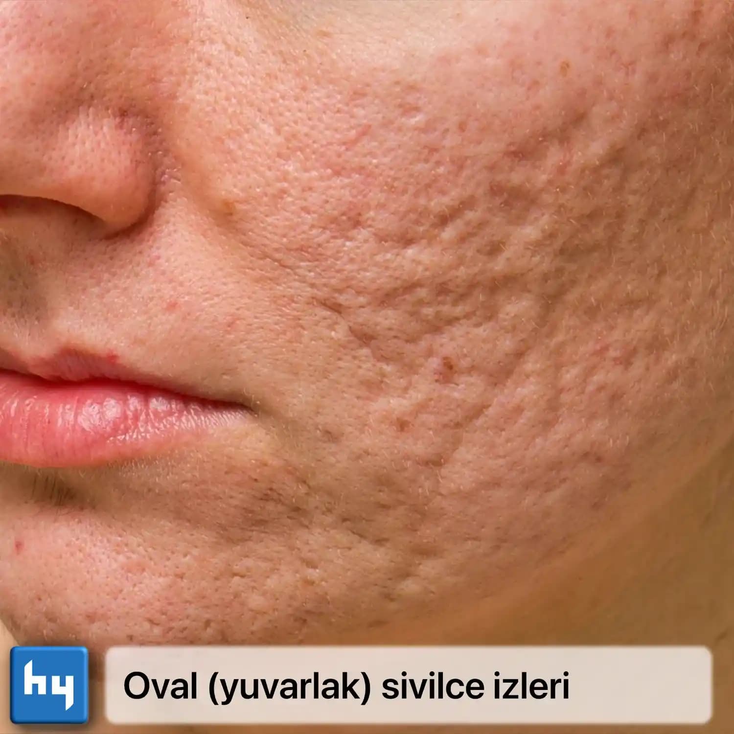 Sivilce İzleri ve Tedavi Yöntemleri: Etkili Çözümler ve Doğal Tavsiyeler