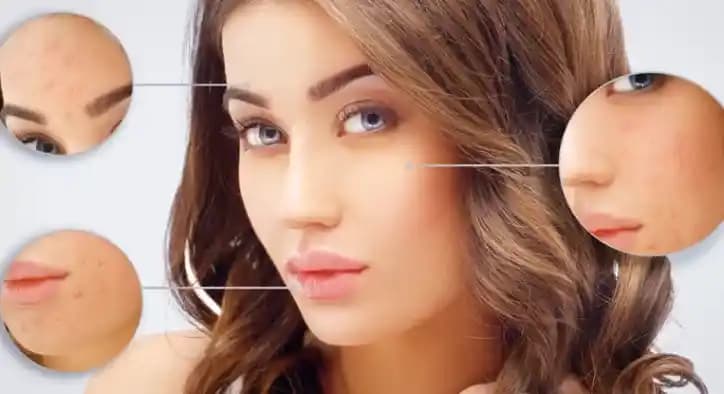 Sivilce İzlerine Karşı Etkili Çözüm Yöntemleri ve Cilt Sağlığı İpuçları