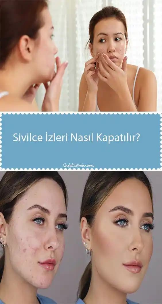 Sivilce İzlerini Azaltma Yöntemleri: Bilimsel ve Doğal Yaklaşımlar